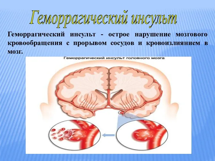 Геморрагический инсульт Геморрагический инсульт - острое нарушение мозгового кровообращения с прорывом сосудов и кровоизлиянием в мозг.
