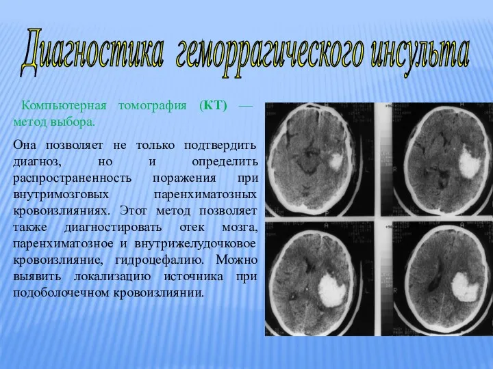 Диагностика геморрагического инсульта Компьютерная томография (КТ) — метод выбора. Она позволяет не только