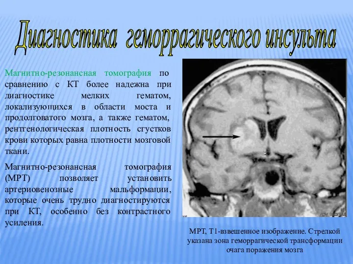 Диагностика геморрагического инсульта Магнитно-резонансная томография по сравнению с КТ более надежна при диагностике