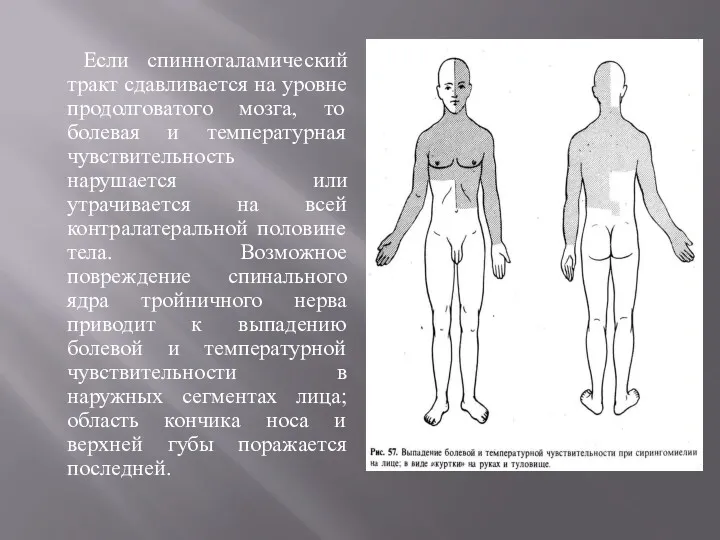 Если спинноталамический тракт сдавливается на уровне продолговатого мозга, то болевая