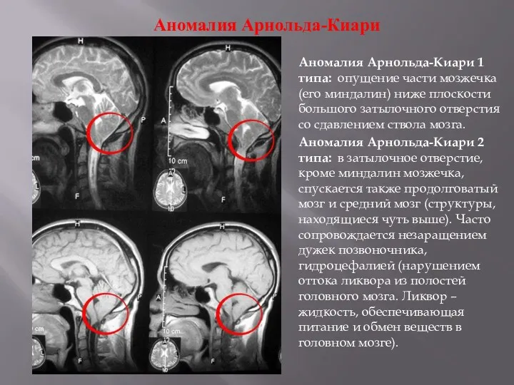 Аномалия Арнольда-Киари Аномалия Арнольда-Киари 1 типа: опущение части мозжечка (его