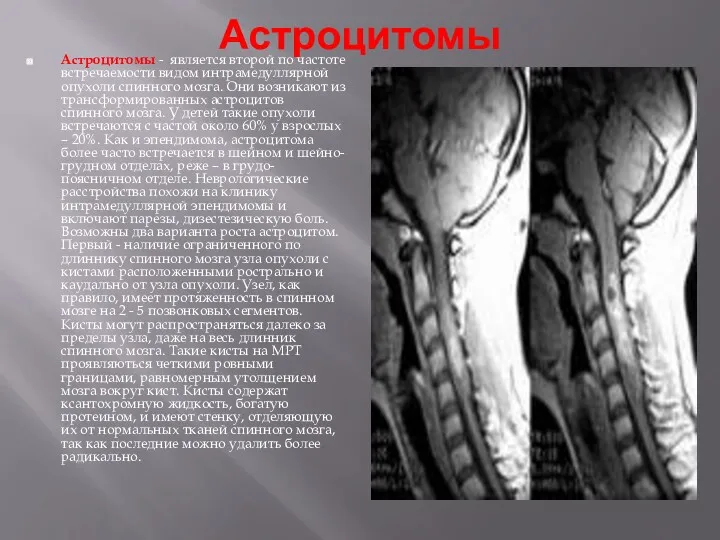 Астроцитомы Астроцитомы - является второй по частоте встречаемости видом интрамедуллярной