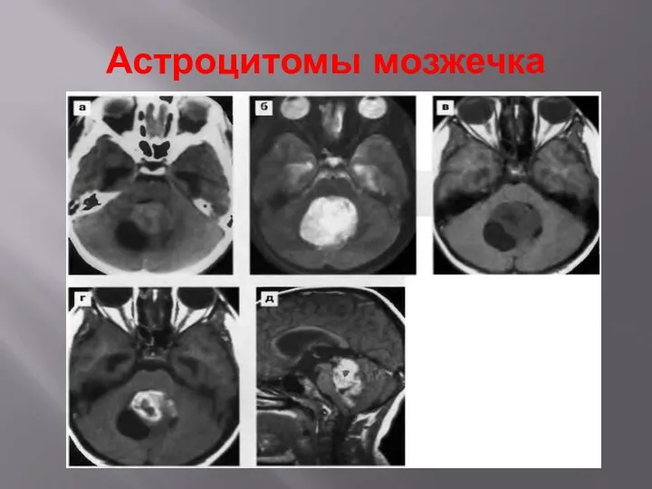 Астроцитомы мозжечка