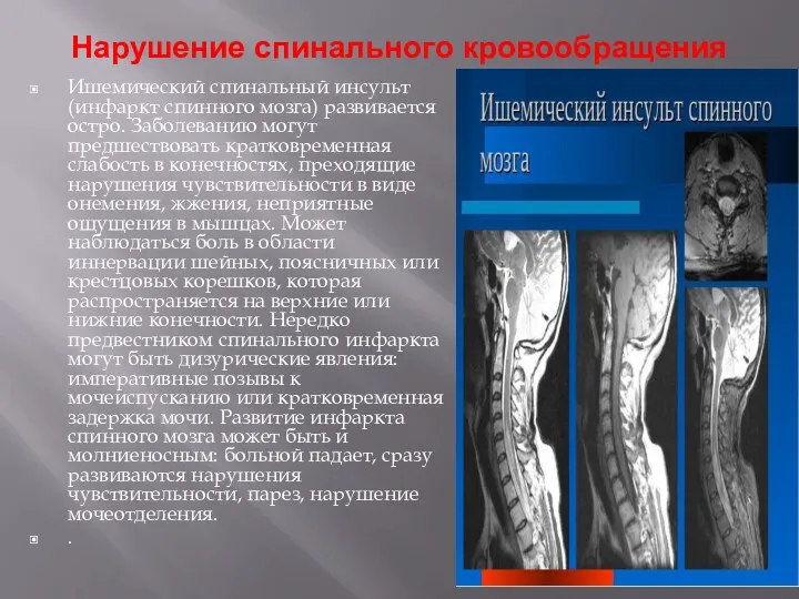 Нарушение спинального кровообращения Ишемический спинальный инсульт (инфаркт спинного мозга) развивается