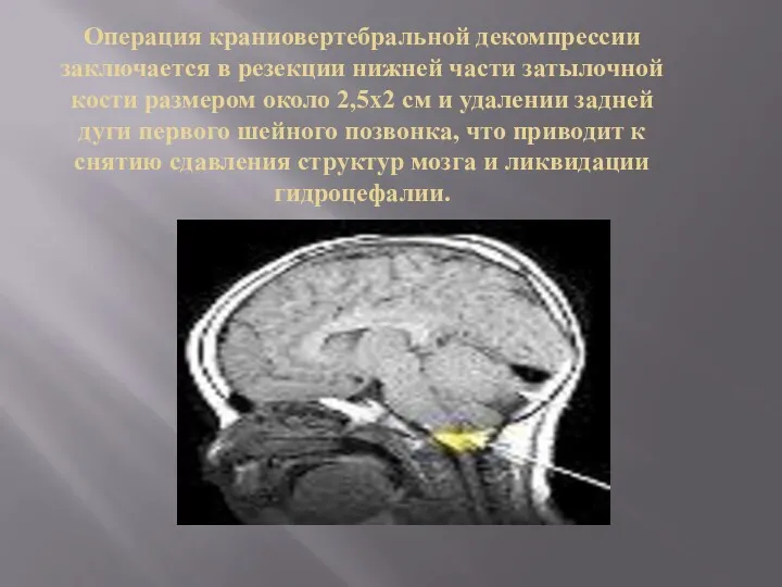 Операция краниовертебральной декомпрессии заключается в резекции нижней части затылочной кости