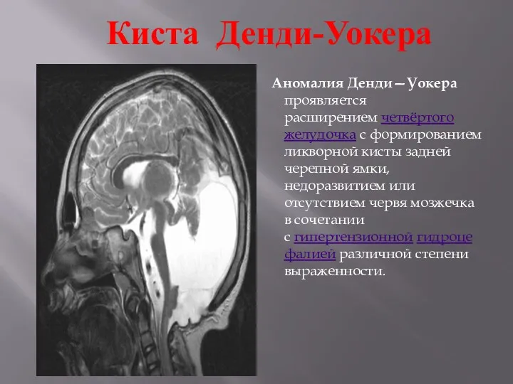 Киста Денди-Уокера Аномалия Денди—Уокера проявляется расширением четвёртого желудочка с формированием