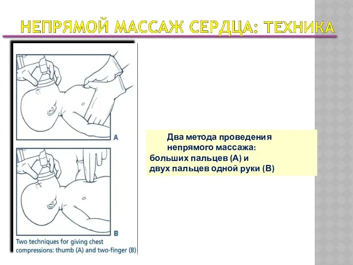 Два метода проведения непрямого массажа: больших пальцев (А) и двух пальцев одной руки (В)