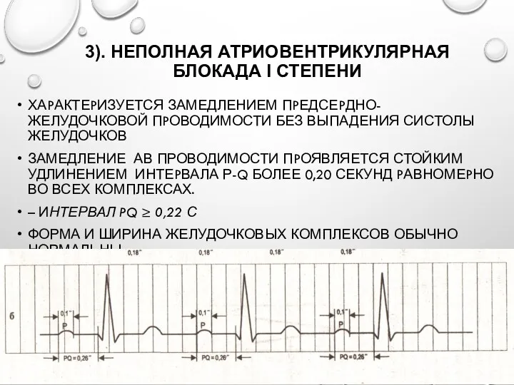 3). НЕПОЛНАЯ АТРИОВЕНТРИКУЛЯРНАЯ БЛОКАДА I СТЕПЕНИ ХАPАКТЕPИЗУЕТСЯ ЗАМЕДЛЕНИЕМ ПPЕДСЕPДНО-ЖЕЛУДОЧКОВОЙ ПPОВОДИМОСТИ