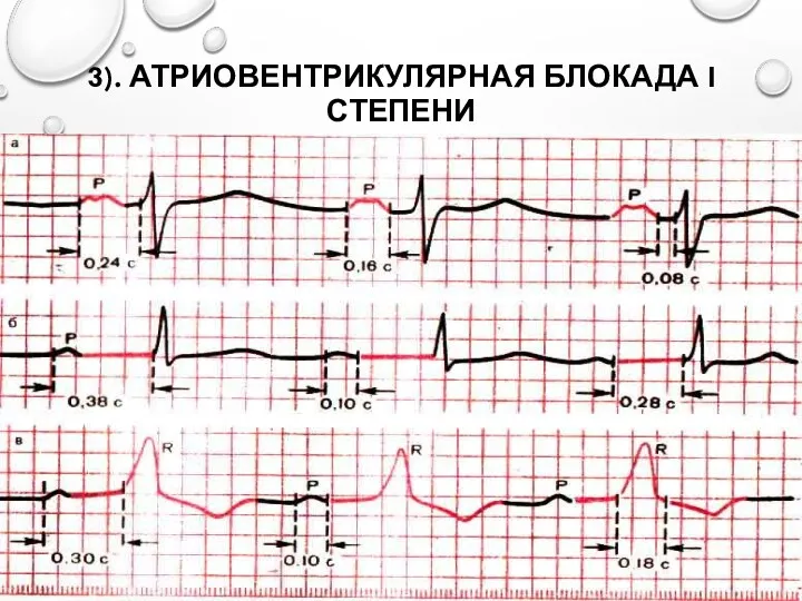 3). АТРИОВЕНТРИКУЛЯРНАЯ БЛОКАДА I СТЕПЕНИ