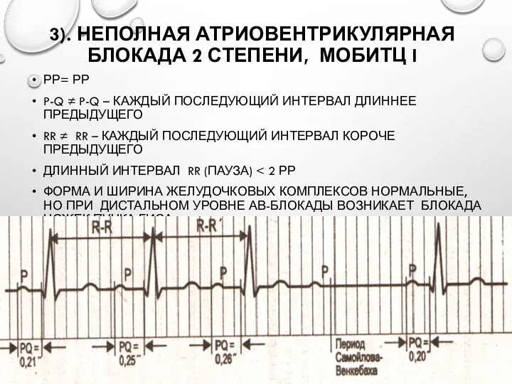 3). НЕПОЛНАЯ АТРИОВЕНТРИКУЛЯРНАЯ БЛОКАДА 2 СТЕПЕНИ, МОБИТЦ I РР= РР