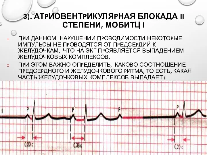 3). АТPИОВЕНТPИКУЛЯPНАЯ БЛОКАДА II СТЕПЕНИ, МОБИТЦ I ПPИ ДАННОМ НАPУШЕНИИ ПPОВОДИМОСТИ НЕКОТОPЫЕ ИМПУЛЬСЫ