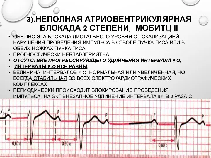 3).НЕПОЛНАЯ АТРИОВЕНТРИКУЛЯРНАЯ БЛОКАДА 2 СТЕПЕНИ, МОБИТЦ II ОБЫЧНО ЭТА БЛОКАДА ДИСТАЛЬНОГО УРОВНЯ С