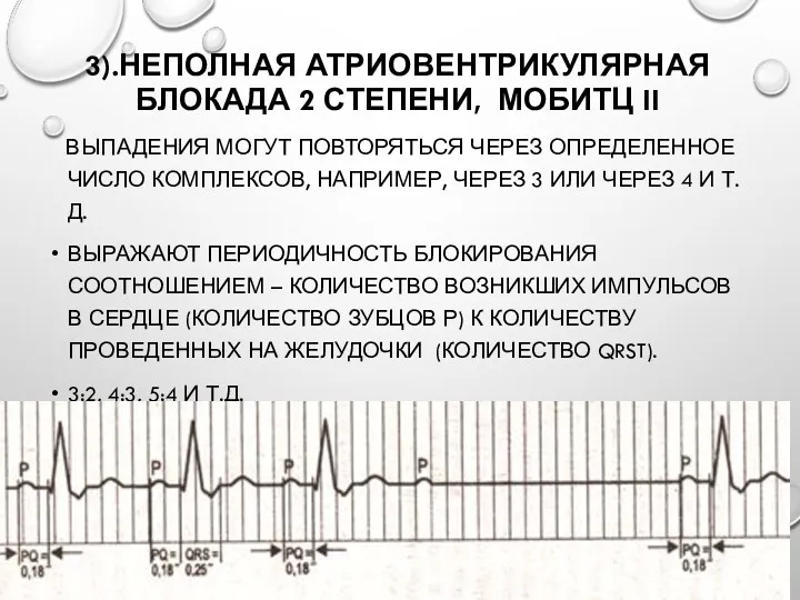 3).НЕПОЛНАЯ АТРИОВЕНТРИКУЛЯРНАЯ БЛОКАДА 2 СТЕПЕНИ, МОБИТЦ II ВЫПАДЕНИЯ МОГУТ ПОВТОРЯТЬСЯ