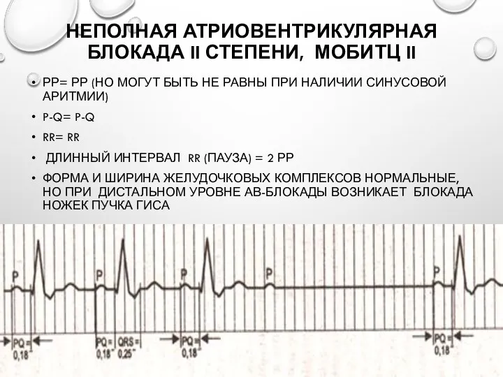 НЕПОЛНАЯ АТРИОВЕНТРИКУЛЯРНАЯ БЛОКАДА II СТЕПЕНИ, МОБИТЦ II РР= РР (НО