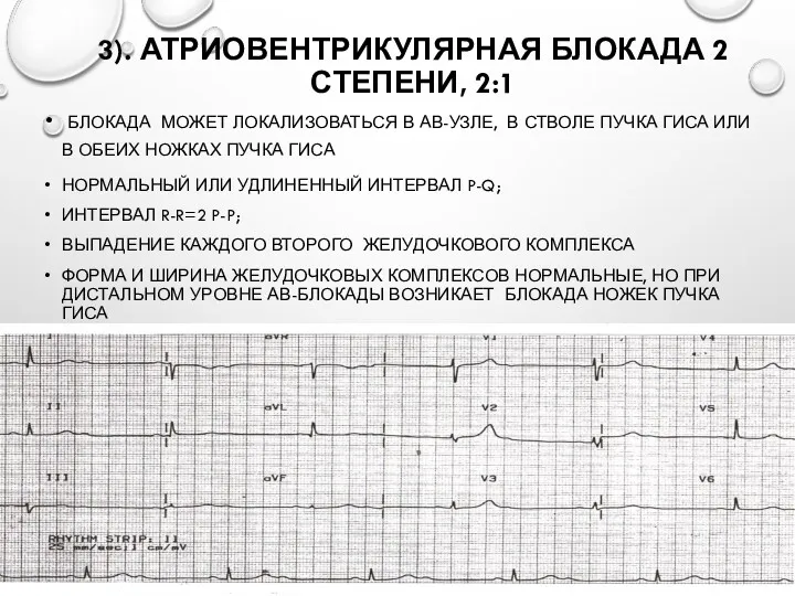 3). АТРИОВЕНТРИКУЛЯРНАЯ БЛОКАДА 2 СТЕПЕНИ, 2:1 БЛОКАДА МОЖЕТ ЛОКАЛИЗОВАТЬСЯ В