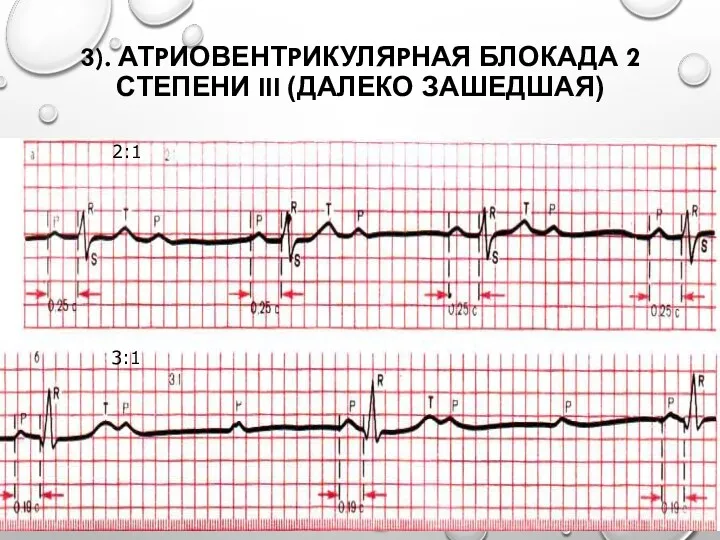 3). АТPИОВЕНТPИКУЛЯPНАЯ БЛОКАДА 2 СТЕПЕНИ III (ДАЛЕКО ЗАШЕДШАЯ) 2:1 3:1