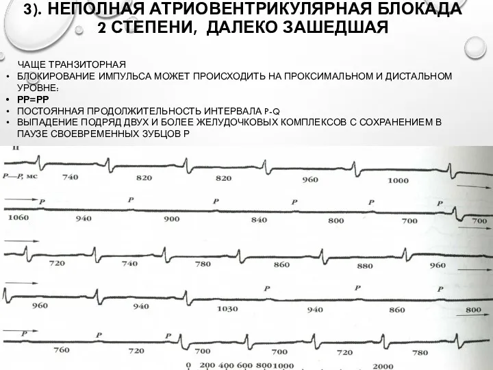 3). НЕПОЛНАЯ АТРИОВЕНТРИКУЛЯРНАЯ БЛОКАДА 2 СТЕПЕНИ, ДАЛЕКО ЗАШЕДШАЯ ЧАЩЕ ТРАНЗИТОРНАЯ БЛОКИРОВАНИЕ ИМПУЛЬСА МОЖЕТ