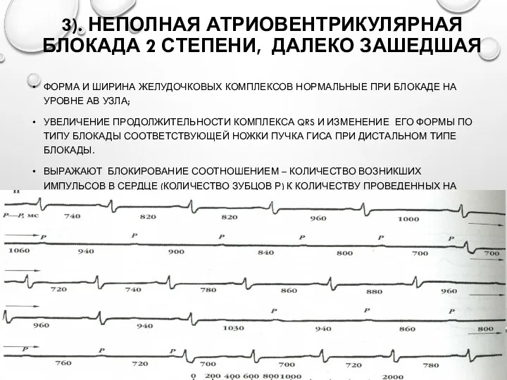 3). НЕПОЛНАЯ АТРИОВЕНТРИКУЛЯРНАЯ БЛОКАДА 2 СТЕПЕНИ, ДАЛЕКО ЗАШЕДШАЯ ФОРМА И ШИРИНА ЖЕЛУДОЧКОВЫХ КОМПЛЕКСОВ