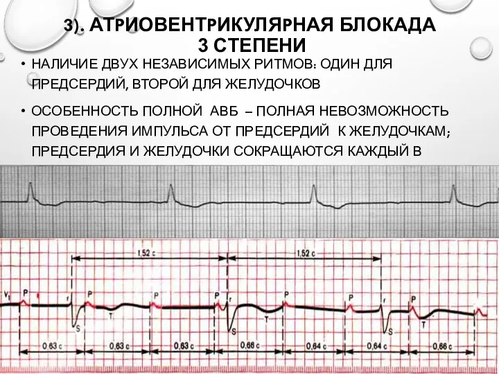 3). АТPИОВЕНТPИКУЛЯPНАЯ БЛОКАДА 3 СТЕПЕНИ НАЛИЧИЕ ДВУХ НЕЗАВИСИМЫХ РИТМОВ: ОДИН