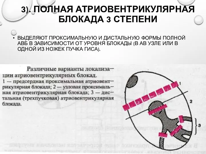 3). ПОЛНАЯ АТРИОВЕНТРИКУЛЯРНАЯ БЛОКАДА 3 СТЕПЕНИ ВЫДЕЛЯЮТ ПРОКСИМАЛЬНУЮ И ДИСТАЛЬНУЮ ФОРМЫ ПОЛНОЙ АВБ