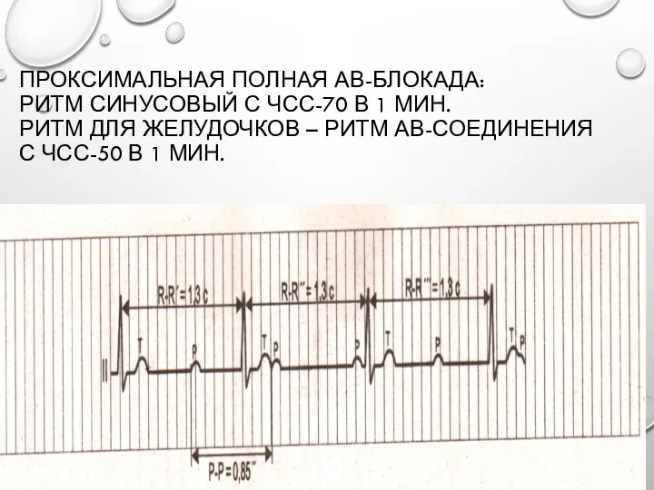 ПРОКСИМАЛЬНАЯ ПОЛНАЯ АВ-БЛОКАДА: РИТМ СИНУСОВЫЙ С ЧСС-70 В 1 МИН.