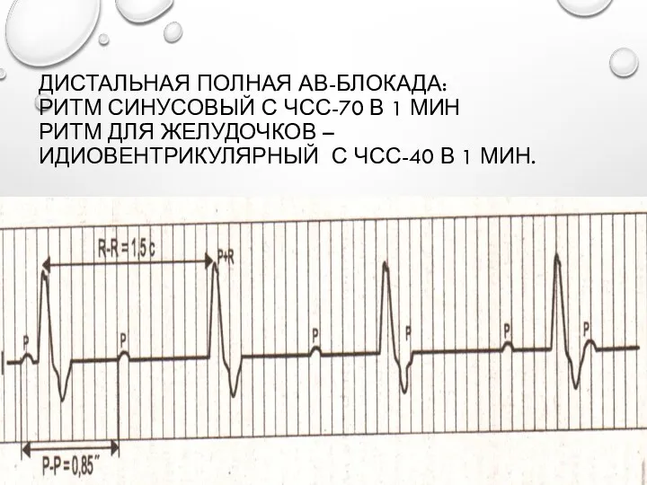 ДИСТАЛЬНАЯ ПОЛНАЯ АВ-БЛОКАДА: РИТМ СИНУСОВЫЙ С ЧСС-70 В 1 МИН РИТМ ДЛЯ ЖЕЛУДОЧКОВ