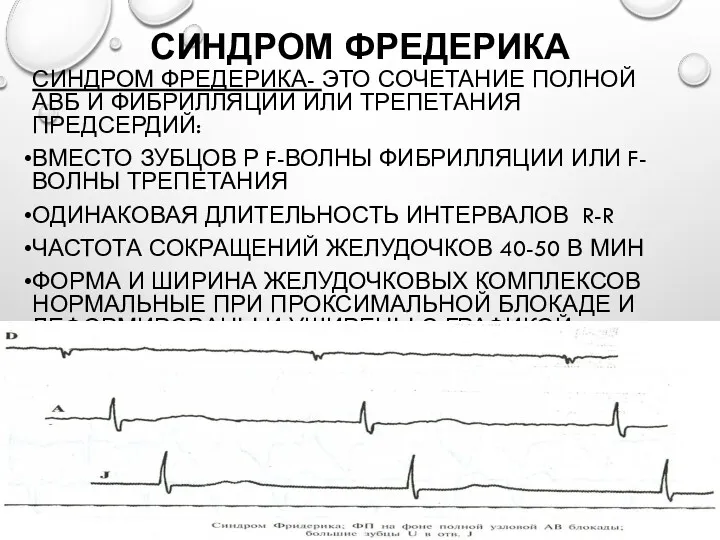 СИНДРОМ ФРЕДЕРИКА СИНДРОМ ФРЕДЕРИКА- ЭТО СОЧЕТАНИЕ ПОЛНОЙ АВБ И ФИБРИЛЛЯЦИИ ИЛИ ТРЕПЕТАНИЯ ПРЕДСЕРДИЙ: