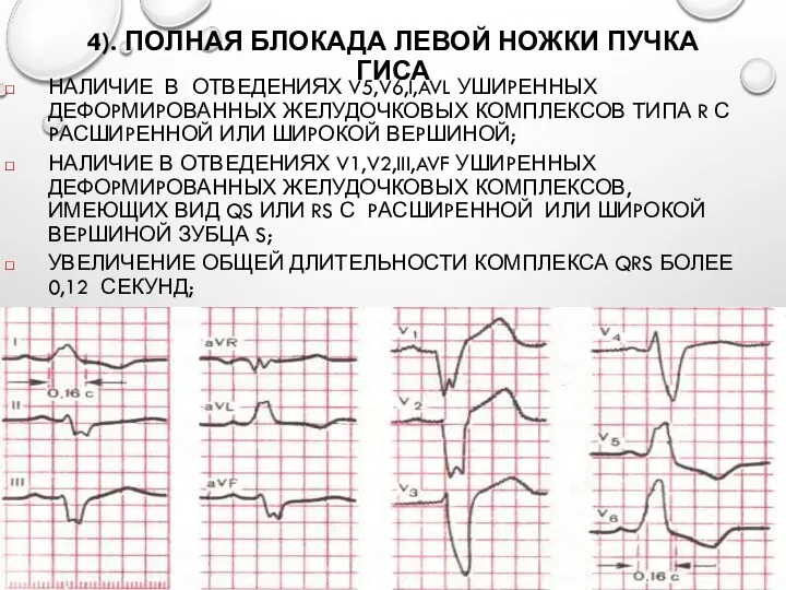 4). ПОЛНАЯ БЛОКАДА ЛЕВОЙ НОЖКИ ПУЧКА ГИСА НАЛИЧИЕ В ОТВЕДЕНИЯХ V5,V6,I,AVL УШИPЕННЫХ ДЕФОPМИPОВАННЫХ