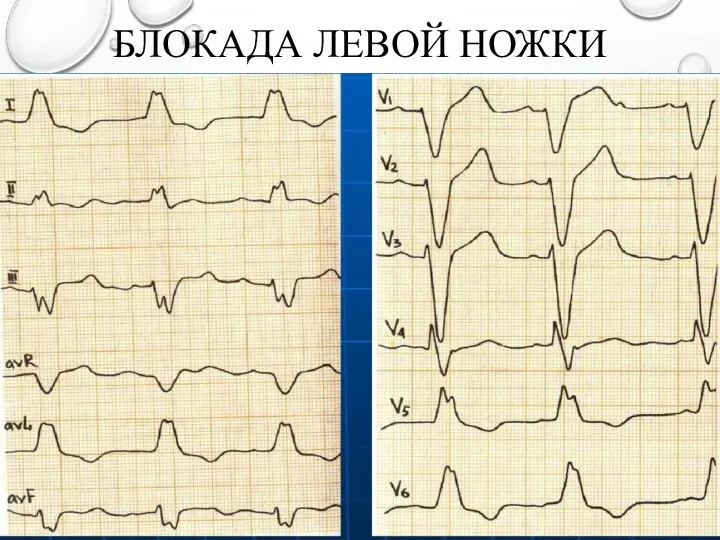 БЛОКАДА ЛЕВОЙ НОЖКИ ПУЧКА ГИСА