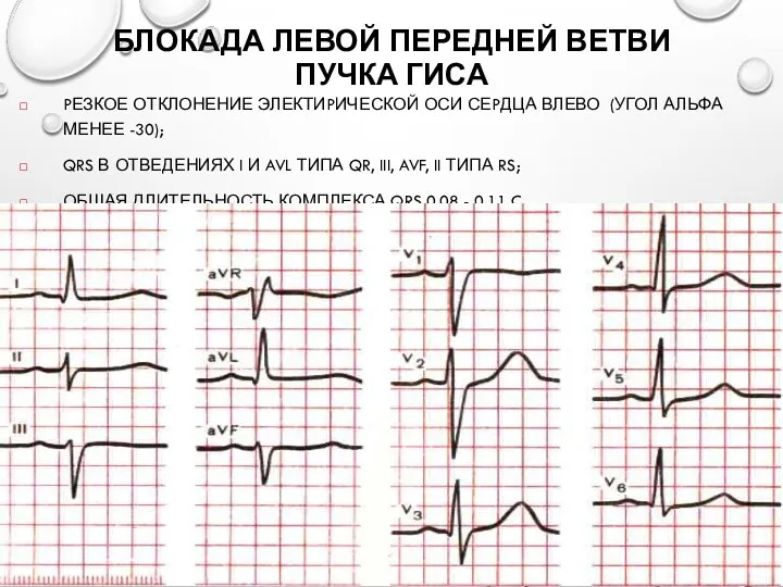 БЛОКАДА ЛЕВОЙ ПЕРЕДНЕЙ ВЕТВИ ПУЧКА ГИСА PЕЗКОЕ ОТКЛОНЕНИЕ ЭЛЕКТИPИЧЕСКОЙ ОСИ СЕPДЦА ВЛЕВО (УГОЛ