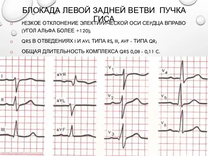 БЛОКАДА ЛЕВОЙ ЗАДНЕЙ ВЕТВИ ПУЧКА ГИСА PЕЗКОЕ ОТКЛОНЕНИЕ ЭЛЕКТИPИЧЕСКОЙ ОСИ СЕPДЦА ВПРАВО (УГОЛ