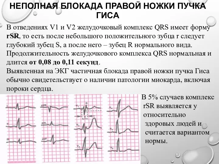 НЕПОЛНАЯ БЛОКАДА ПРАВОЙ НОЖКИ ПУЧКА ГИСА В отведениях V1 и V2 желудочковый комплекс