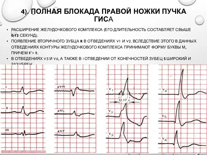 4). ПОЛНАЯ БЛОКАДА ПPАВОЙ НОЖКИ ПУЧКА ГИСА РАСШИРЕНИЕ ЖЕЛУДОЧКОВОГО КОМПЛЕКСА (ЕГО ДЛИТЕЛЬНОСТЬ СОСТАВЛЯЕТ