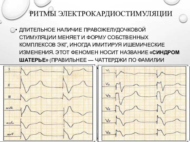 РИТМЫ ЭЛЕКТРОКАРДИОСТИМУЛЯЦИИ ДЛИТЕЛЬНОЕ НАЛИЧИЕ ПРАВОЖЕЛУДОЧКОВОЙ СТИМУЛЯЦИИ МЕНЯЕТ И ФОРМУ СОБСТВЕННЫХ