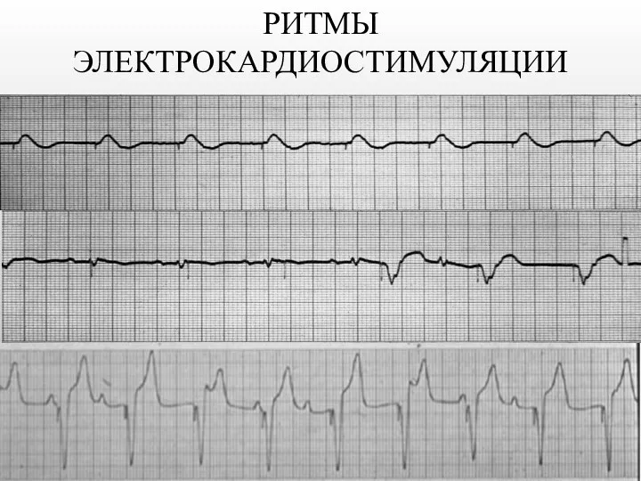 РИТМЫ ЭЛЕКТРОКАРДИОСТИМУЛЯЦИИ