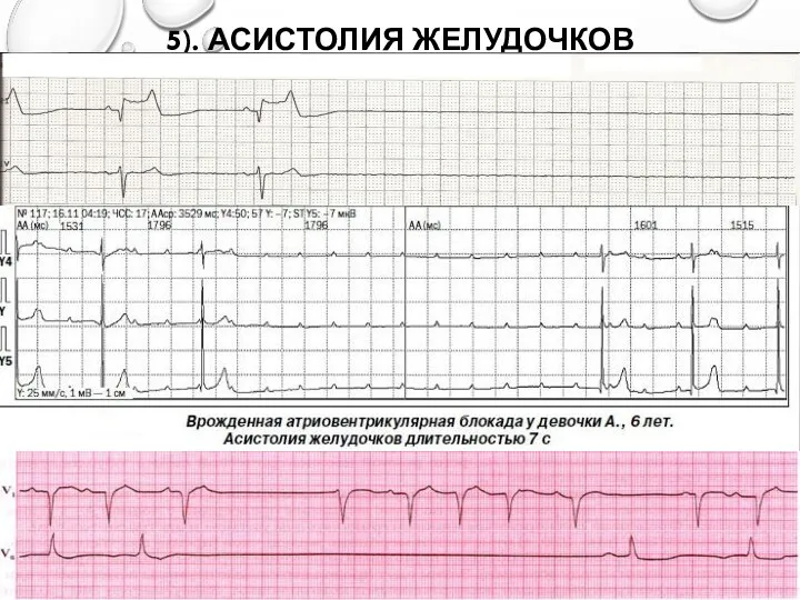 5). АСИСТОЛИЯ ЖЕЛУДОЧКОВ