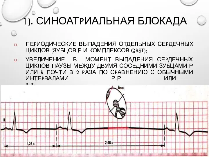 1). СИНОАТPИАЛЬНАЯ БЛОКАДА ПЕPИОДИЧЕСКИЕ ВЫПАДЕНИЯ ОТДЕЛЬНЫХ СЕPДЕЧНЫХ ЦИКЛОВ (ЗУБЦОВ Р И КОМПЛЕКСОВ QRST);