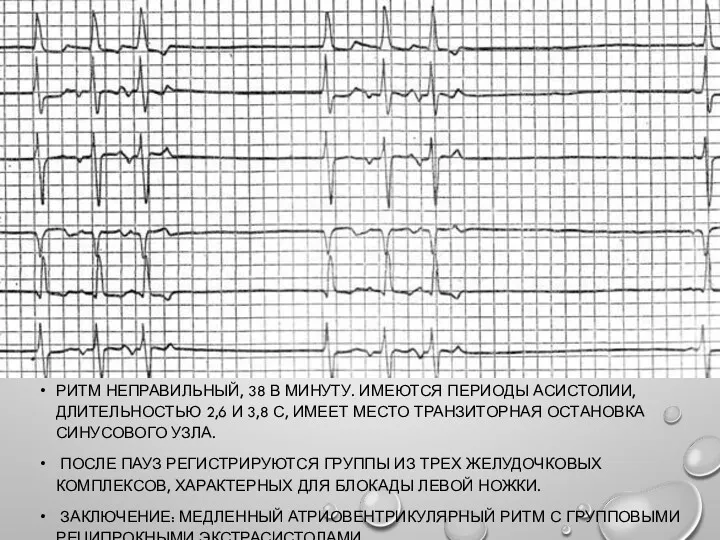 РИТМ НЕПРАВИЛЬНЫЙ, 38 В МИНУТУ. ИМЕЮТСЯ ПЕРИОДЫ АСИСТОЛИИ, ДЛИТЕЛЬНОСТЬЮ 2,6 И 3,8 С,