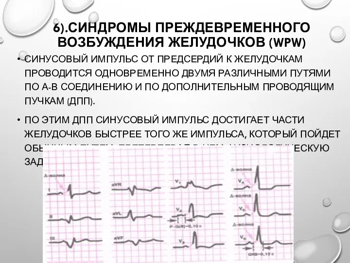 6).СИНДРОМЫ ПРЕЖДЕВРЕМЕННОГО ВОЗБУЖДЕНИЯ ЖЕЛУДОЧКОВ (WPW) СИНУСОВЫЙ ИМПУЛЬС ОТ ПРЕДСЕРДИЙ К ЖЕЛУДОЧКАМ ПРОВОДИТСЯ ОДНОВРЕМЕННО