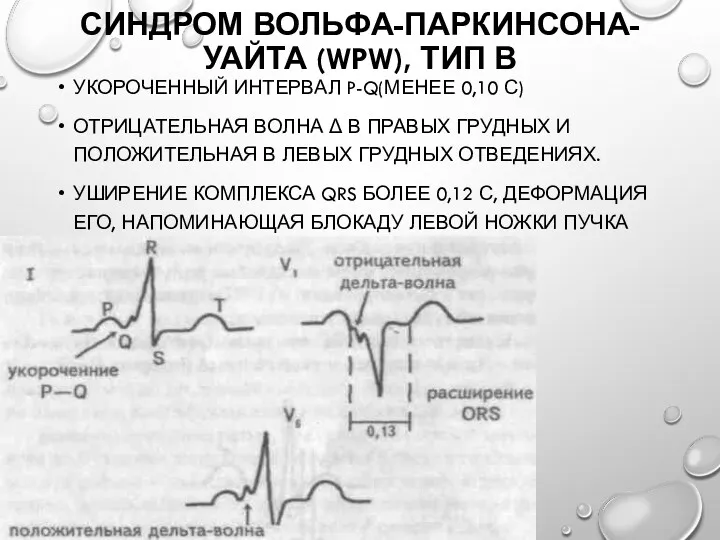 СИНДРОМ ВОЛЬФА-ПАРКИНСОНА-УАЙТА (WPW), ТИП В УКОРОЧЕННЫЙ ИНТЕРВАЛ P-Q(МЕНЕЕ 0,10 С) ОТРИЦАТЕЛЬНАЯ ВОЛНА Δ