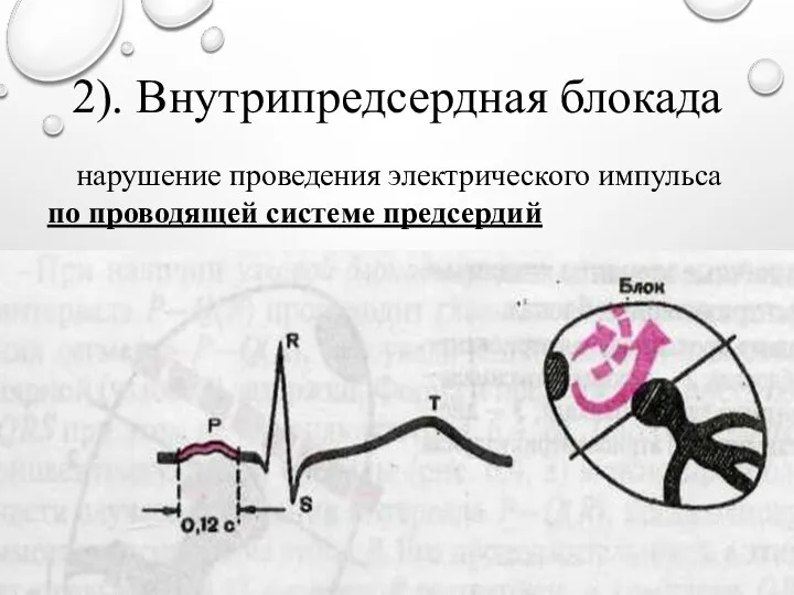 2). Внутрипредсердная блокада нарушение проведения электрического импульса по проводящей системе предсердий