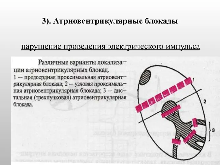 3). Атриовентрикулярные блокады нарушение проведения электрического импульса