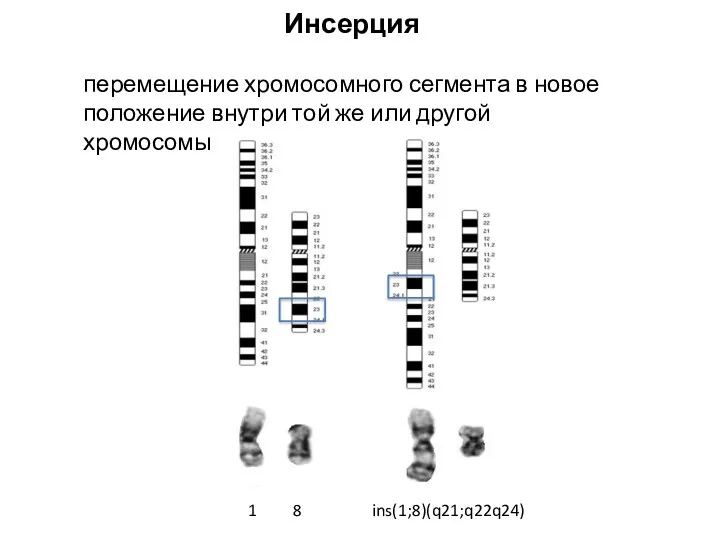 Инсерция перемещение хромосомного сегмента в новое положение внутри той же или другой хромосомы 1 8 ins(1;8)(q21;q22q24)