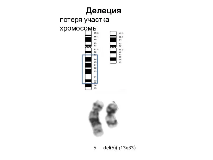 Делеция потеря участка хромосомы 5 del(5)(q13q33)