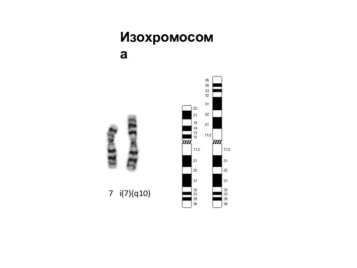 Изохромосома 7 i(7)(q10)