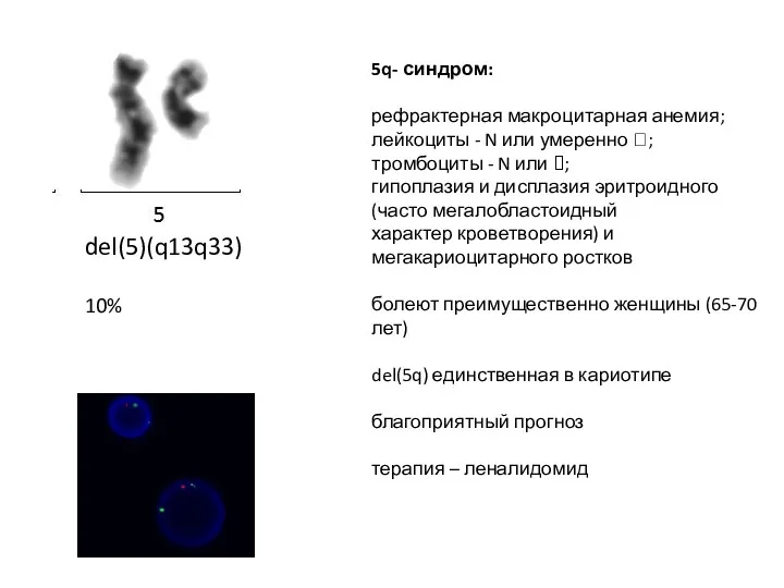 del(5)(q13q33) 10% 5q- синдром: рефрактерная макроцитарная анемия; лейкоциты - N