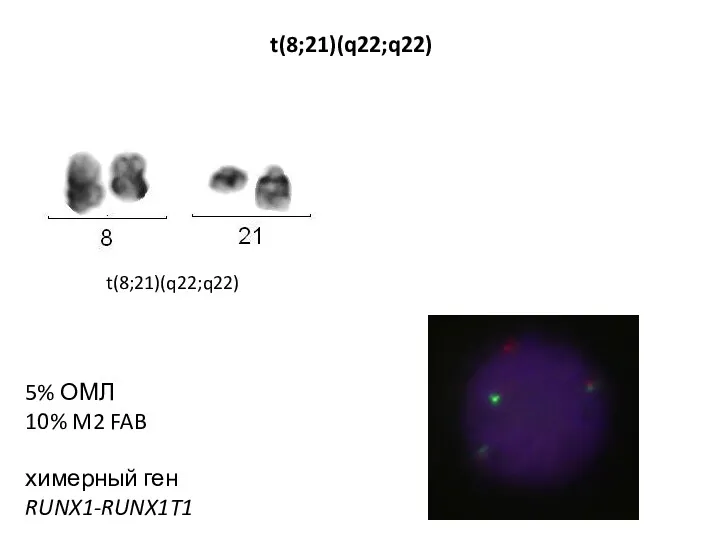 5% ОМЛ 10% M2 FAB химерный ген RUNX1-RUNX1T1 t(8;21)(q22;q22) t(8;21)(q22;q22)