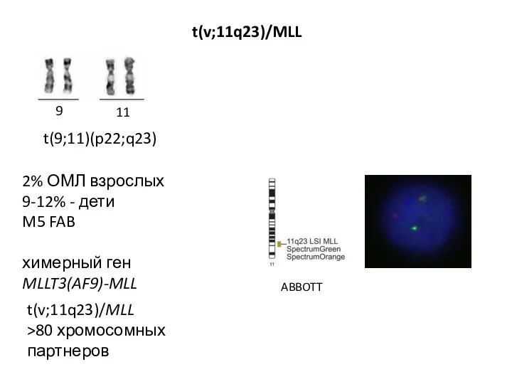 9 11 t(9;11)(p22;q23) 2% ОМЛ взрослых 9-12% - дети M5 FAB химерный ген