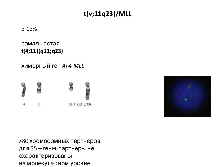 5-15% самая частая t(4;11)(q21;q23) химерный ген AF4-MLL t(v;11q23)/MLL >80 хромосомных