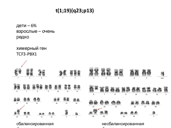 t(1;19)(q23;p13) дети – 6% взрослые – очень редко химерный ген TCF3-PBX1 сбалансированная форма несбалансированная форма